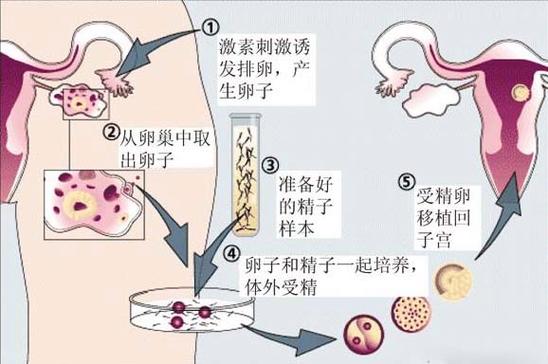 北京供卵试管包成功-北京供卵试管包成功指南